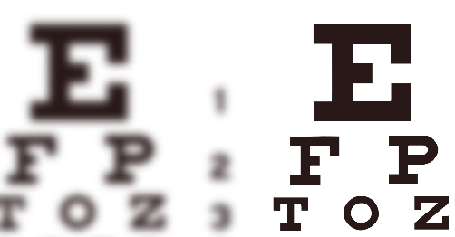 Right and Left Refractive Amblyopia Definition, Symptoms, Causes, Treatment