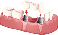 Dental Implants by Dr. Adams