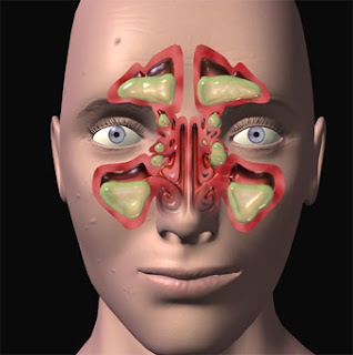 sinusitis symptoms, symptoms of sinusitis, symptoms sinusitis, symptoms for sinusitis, acute sinusitis, sinusitis acute, fungal sinusitis, sphenoid sinusitis, maxillary sinusitis, sinusitis remedies, remedies for sinusitis, remedies sinusitis, sinusitis treatments, treatments for sinusitis, sinusitis remedy, remedy for sinusitis, severe sinusitis, ethmoidal sinusitis