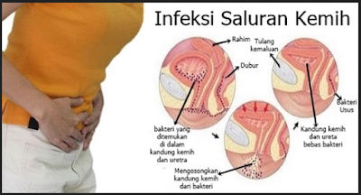 Obat Infeksi Saluran Kemih (ISK) Tradisional