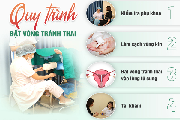 Quy trình đặt vòng tránh thai ở Nghệ An