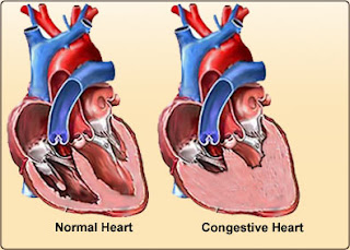 Nursing Assessment for Congestive Heart Failure
