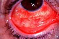 Klinik Kesihatan: Penyakit mata konjungtivitis
