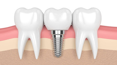 Làm răng implant mất bao lâu khi phục hình răng số 4?-2