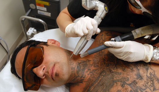 Before Tattoo Removal Treatments, After Tattoo Removal Treatments