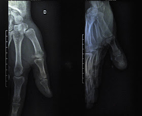 An X-ray of the author's right hand!