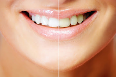 natural teeth whitening