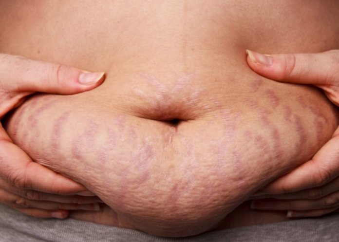 Cegah Stretch Mark Dengan Pengobatan Rumah Alami ini