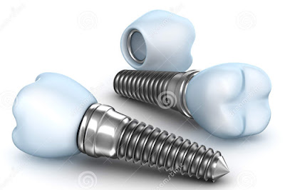 Trồng răng implant giá bao nhiêu