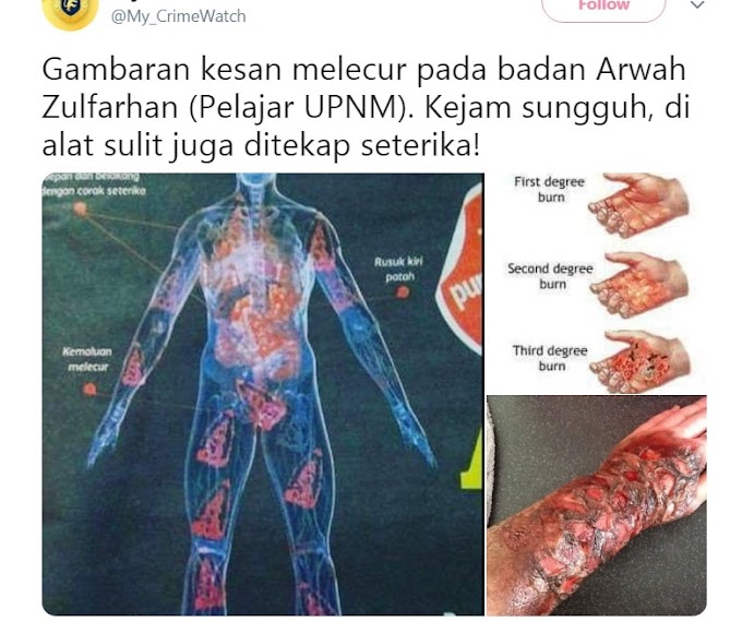 Gambaran kesan melecur pada badan Arwah Zulfarhan (Pelajar UPNM) ~ Wordless Wednesday