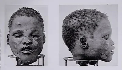 Kομμένο κεφάλι Αφρικανού – σοκαριστικό