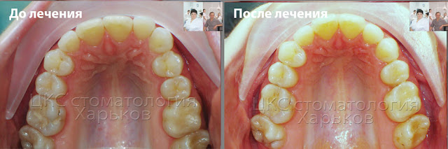 Форма верхнего зубного ряда до и после лечения ортодонтического лечения