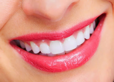 Làm sao để tẩy trắng răng an toàn?