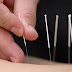 العلاج بالإبر الصينية Acupuncture