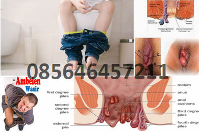 Menghentikan Wasir Berdarah dengan Ambejoss