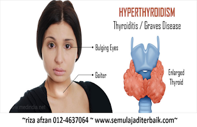 hyperthyroidism vivix