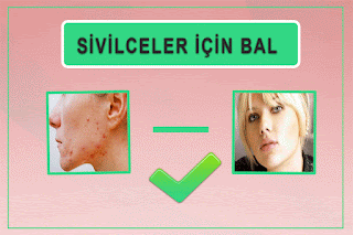 Sivilceler İçin Bal