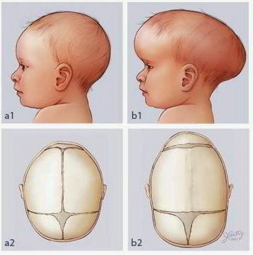 Kepala Bayi bunda Peyang? Berikut Penyebab dan Cara 