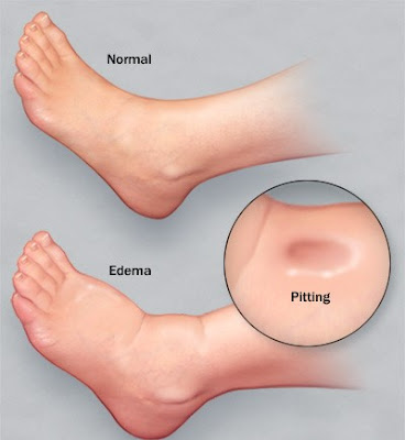 Pitting Edema