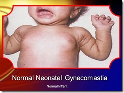 neonatal gyncomastia medicalshow