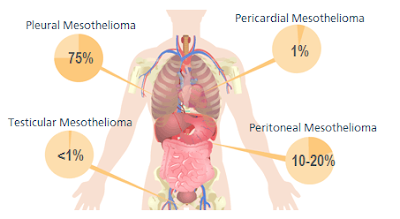 Types Mesothelioma