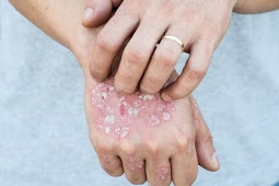 Psoriasis, a chronic skin disease that can be treated with marijuana