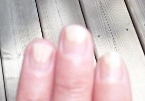 Top 70 of Nail Detached From Nail Bed