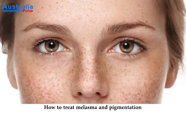 How to treat melasma and pigmentation?