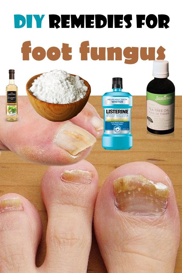 Foot Fungus Treatment