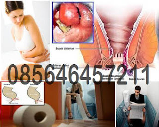 Obat Wasir Hemorrhoid Yang di Jual Online