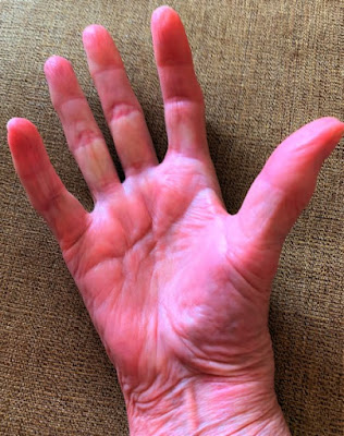 Dupuytren contracture