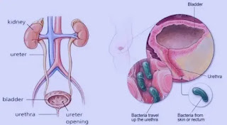 ما هو التهاب المسالك البولية؟ أسباب التهابات المسالك البولية .