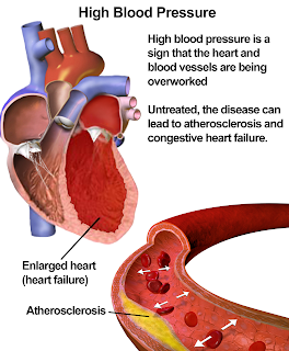 What is hypertension,mean,hypertension heart disease