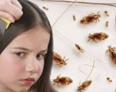 How To Get Rid Of Lice Fast
