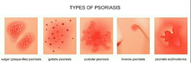 सोरायसिस के प्रकार 1 - Plague Psoriasis   2 - Guttate Psoriasis  3 - Inverse Psoriasis  4 - Pustular Psoriasis  5 - Erythroderma Psoriasis