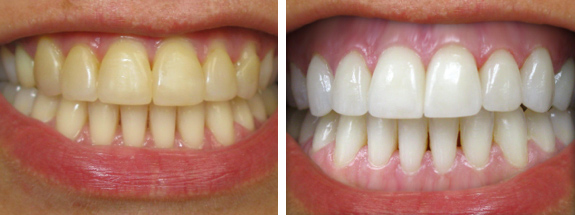 Nano Shining 5S – công nghệ phục hình răng hoàn hảo không đau