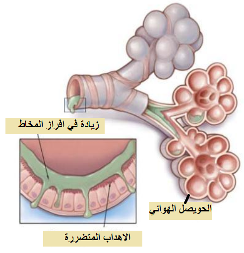 مرض الانسداد الرئوي المزمن (COPD) chronic obstructive pulmonary disease