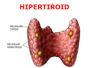 hipertiroid