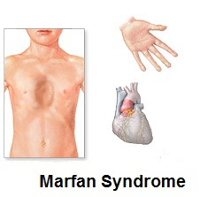 Marfan Syndrome Signs, Symptoms And Treatment