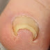 How to treat for ingrown nails immediately 