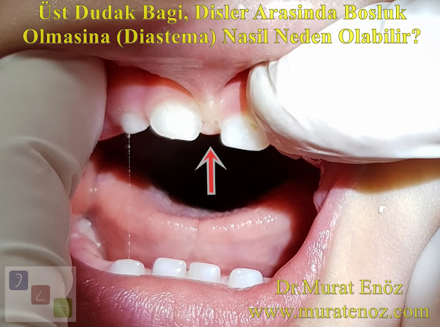 Dudak Bağına Bağlı Emzirme Sorunu Haricinde Görülebilen İki Problem Üst Dişler Arasında Boşluk Olması (Diastema) ve Erken Diş Çürümesidir! - Üst Dudak Bağı, Diş Çürümesini Nasıl Kolaylaştırır? - Üst Dudak Bağı, Dişler Arasında Boşluk Olmasına (Diastema) Nasıl Neden Olabilir? - Diş Eti Çizgisinde Çukurlaşmaya Neden Olan Dudak Bağlarında Dişlerde Ayrılma Ortaya Çıkması Daha Olasıdır! - Normal Labial Frenulum da da Dudak Bağı Olan Hastalarda da Dişler Arasında Ayrılma Görülebilir! - Dudak Bağı Kesilmesi Her Zaman Dişlerin Yeniden Kapanması İçin Yeterli Değildir! - Emzirme Sorunu İçin Yapılan Dudak Bağı Kesilmesi İşleminde Genelde Dişler Arasındaki Doku Çıkarılmıyor! - Maxillary Midline Diastema - Upper Lip Ties (ULT)