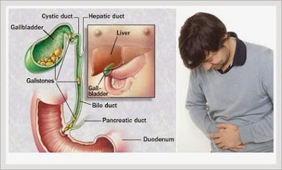 Cara Mengobati Penyakit Batu Empedu