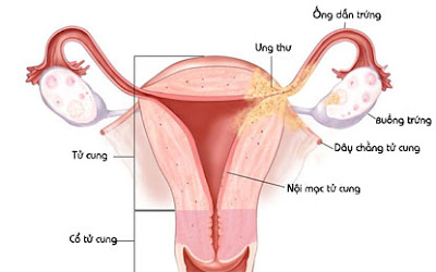 Tìm hiểu về bệnh viêm nội mạc tử cung