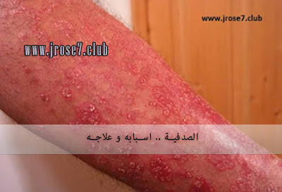 الصدفية,psoriasis,علاج,وقاية,صحة,اسباب الصدفية,اعراض الصدفية,علاج الصدفية مجرب