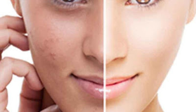 How To Tackle dark spots and uneven complexion in 4 weeks
