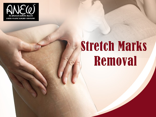 stretch marks removal in Goa