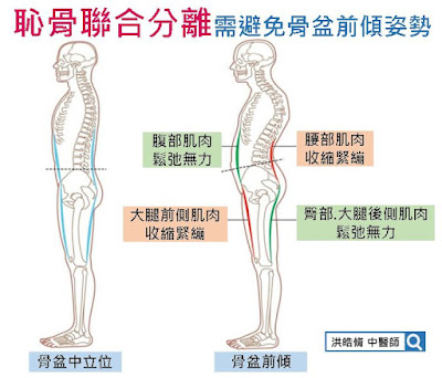 產後恥骨聯合分離, 恥骨分離, 中醫, 針灸, 中藥, 復健, 治療, 止痛