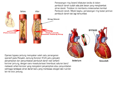 gambar baypass jantung