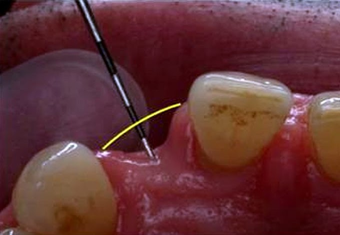 CIRUGÍA ORAL: Injertos óseos de mentón para la reconstrucción de defectos óseos