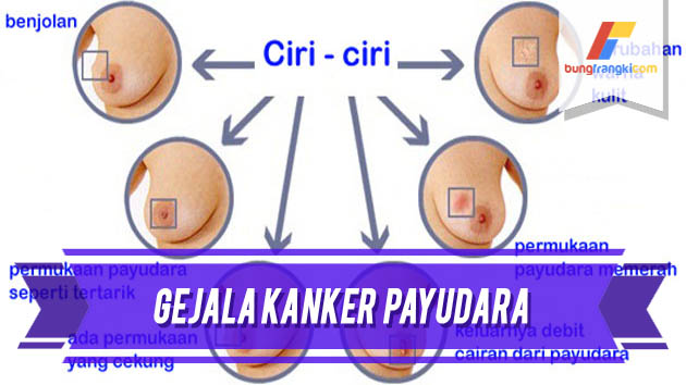 Gejala Kanker Payud*ra yang Bisa Dilihat Langsung